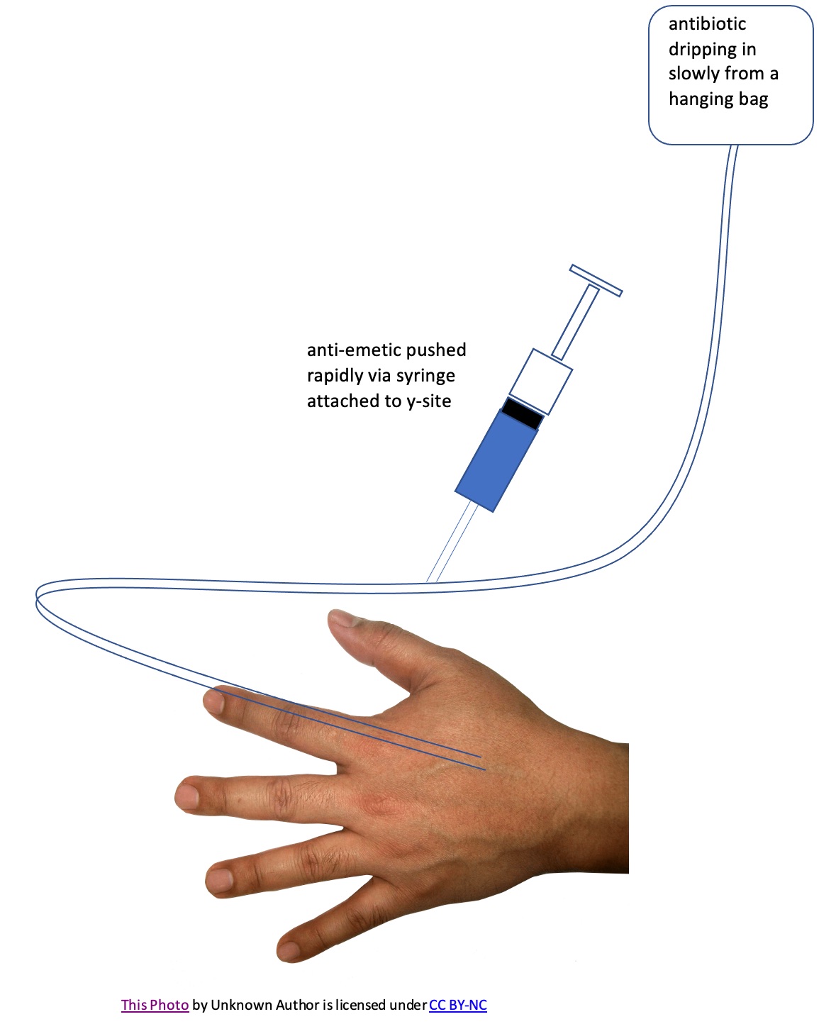 graphic of an antibiotic being delivered IV from a hanging bag while the y-site is being used to deliver an anti-emetic from a syringe.