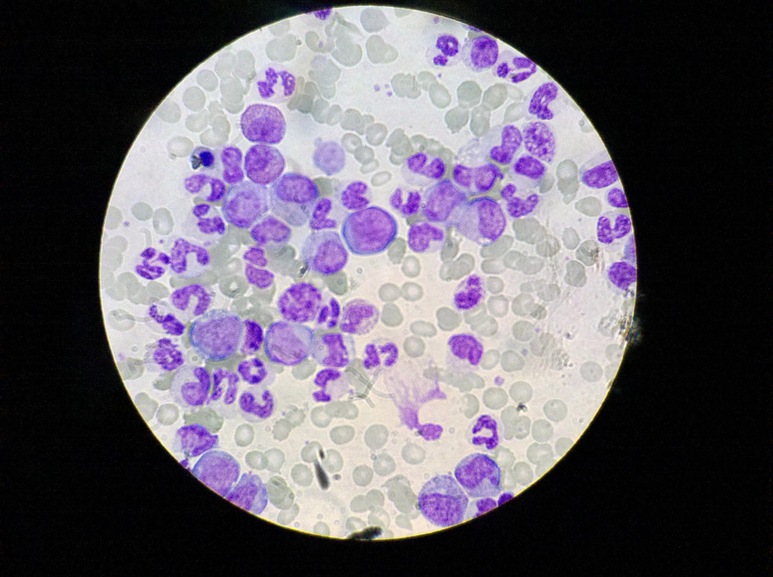 A blood smear showing presence of CML