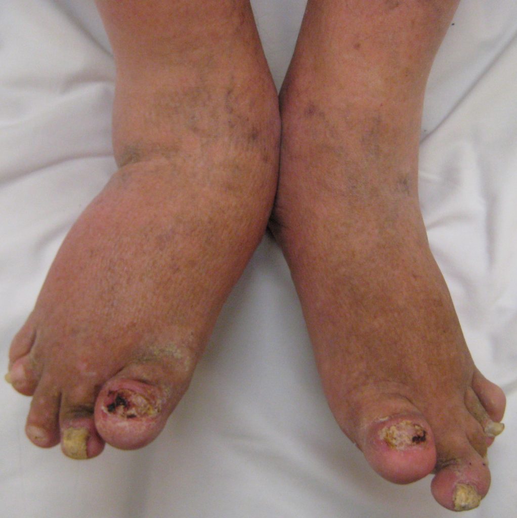 Photo of the feet of a patient with severe psoriatric arthritis